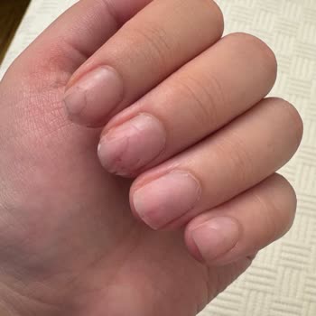 Rosh Beauty Nail İncirli Şubesinde Protez Tırnak Çıkarma Sonrası Ciddi Morarma Ve Kanama