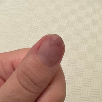 Rosh Beauty Nail İncirli Şubesinde Protez Tırnak Çıkarma Sonrası Ciddi Morarma Ve Kanama