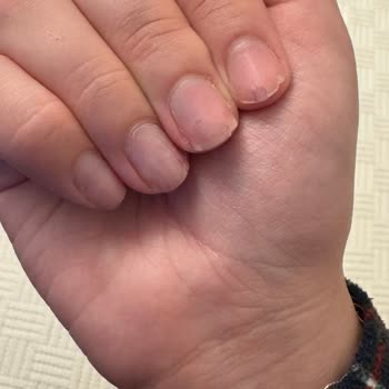 Rosh Beauty Nail İncirli Şubesinde Protez Tırnak Çıkarma Sonrası Ciddi Morarma Ve Kanama