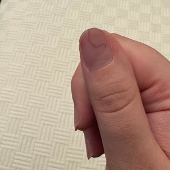 Rosh Beauty Nail İncirli Şubesinde Protez Tırnak Çıkarma Sonrası Ciddi Morarma Ve Kanama