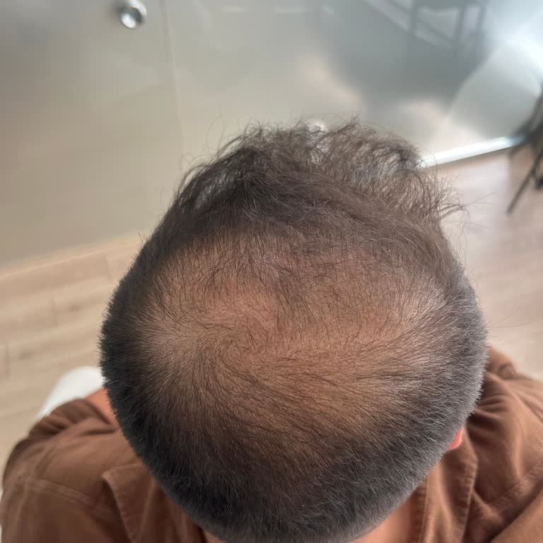 S Klinik Antalya’da Saç Tedavisinde Sonuç Alamama Ve Güven Kaybı