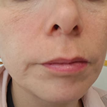 İdefix'ten Süre Sonu Geçmiş La Roche Cicaplast Baume Yüz Kremi: Şiddetli Kızarıklık Ve Kaşıntı