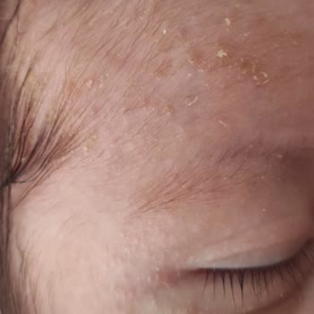 Mustela Yenidoğan Şampuanı Bebekte Cilt Kuruluğu Ve Egzama Yaratıyor