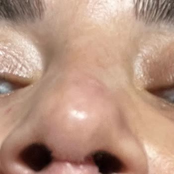 Dört Kez Rinoplasti Sonrası Hastane Ve Doktor Sorumluluğu Talebi