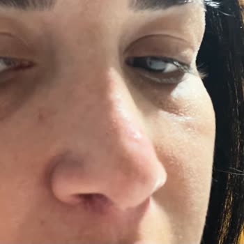 Dört Kez Rinoplasti Sonrası Hastane Ve Doktor Sorumluluğu Talebi