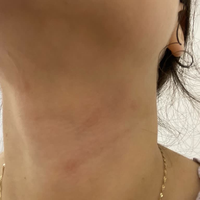 Eve Shop Mağazasında Ürün İadesi Reddi Ve Cilt Reaksiyonu