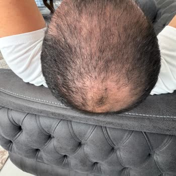 Gold City Hair Acıbadem Şubesinde Saç Ekimi Sonuçsuz Ve Ücret İstemi