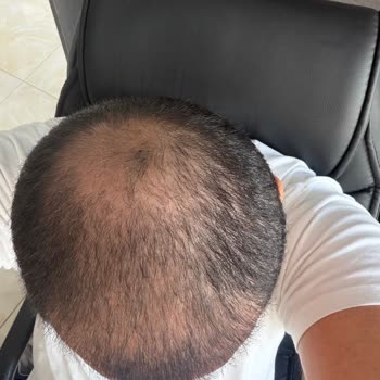 Gold City Hair Acıbadem Şubesinde Saç Ekimi Sonuçsuz Ve Ücret İstemi