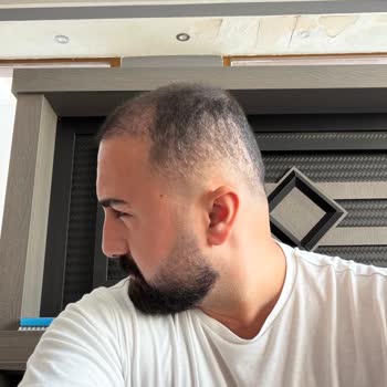 Gold City Hair Acıbadem Şubesinde Saç Ekimi Sonuçsuz Ve Ücret İstemi