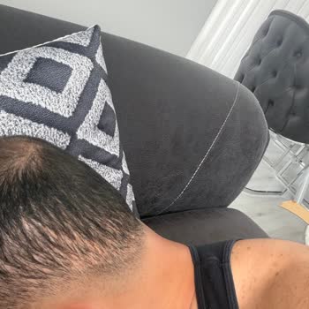 Gold City Hair Acıbadem Şubesinde Saç Ekimi Sonuçsuz Ve Ücret İstemi