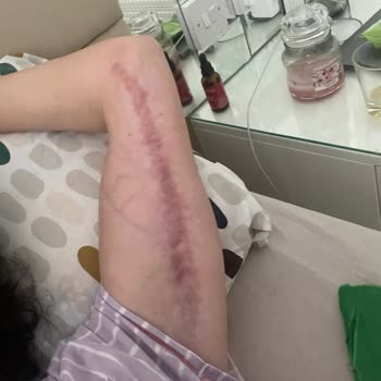 Op. Dr. Muhammet Eren Ersöz Kol Kaldırma Ameliyatı Sonrası Kalıcı İz Ve His Kaybı