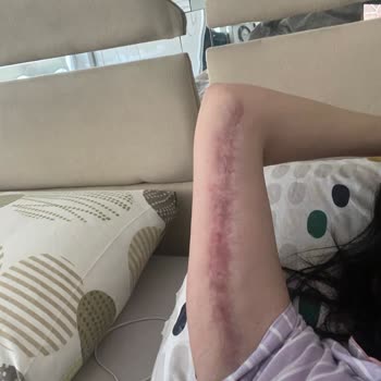 Op. Dr. Muhammet Eren Ersöz Kol Kaldırma Ameliyatı Sonrası Kalıcı İz Ve His Kaybı