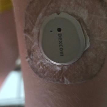 Dexcom G7 Sensöründeki Ölçüm Hatası Ve Teknik Destek İhmali Çocuğumuzun Sağlığını Tehlikeye Atıyor