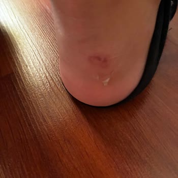 Skechers Hazal Step N Flow Ayakkabısında Üretim Hatası Ve Cilt Tahrişi