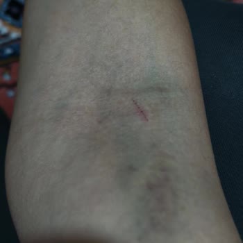 Kan Alma Sonrası Şiddetli Morarma Ve Ağrı