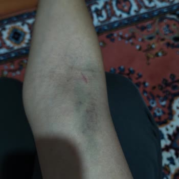 Kan Alma Sonrası Şiddetli Morarma Ve Ağrı