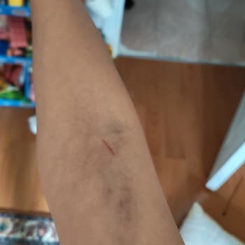 Kan Alma Sonrası Şiddetli Morarma Ve Ağrı