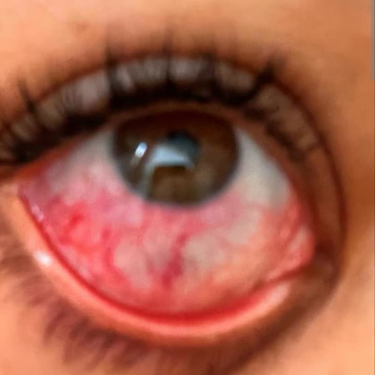 Kirpik Yapıştırıcısı Göz Yanmasına Neden Oldu, Salon Çözüm Sunmadı Ve İade Talep Ediliyor