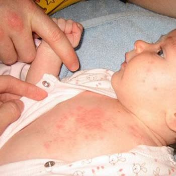 Temu Çocuk Kıyafeti Alerjik Reaksiyon Nedeniyle Para İadesi Talebi