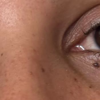 Markalens Solüsyondan Kaynaklanan Göz Enfeksiyonu Ve 8 Bin TL’lik Maddi Zarar
