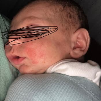 Mustela Stelatopia Ürünleri Bebekte Şiddetli Alerjik Reaksiyon Ve Ücret İadesi Talebi