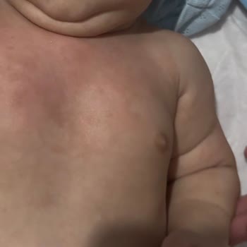 Mustela Stelatopia Ürünleri Bebekte Şiddetli Alerjik Reaksiyon Ve Ücret İadesi Talebi