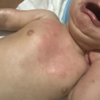 Mustela Stelatopia Ürünleri Bebekte Şiddetli Alerjik Reaksiyon Ve Ücret İadesi Talebi