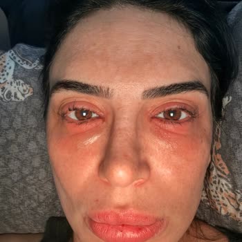 Flormar Göz Kalemi Kullanımından Sonra Şiddetli Alerjik Reaksiyon Ve Şirketin Yetersiz Cevabı
