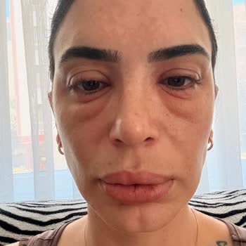 Flormar Göz Kalemi Kullanımından Sonra Şiddetli Alerjik Reaksiyon Ve Şirketin Yetersiz Cevabı