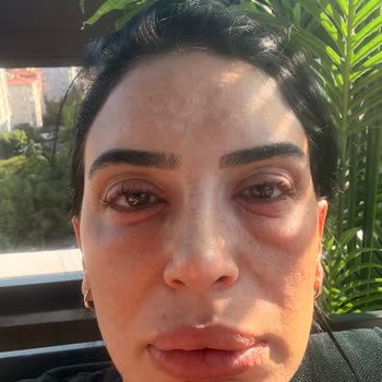 Flormar Göz Kalemi Kullanımından Sonra Şiddetli Alerjik Reaksiyon Ve Şirketin Yetersiz Cevabı