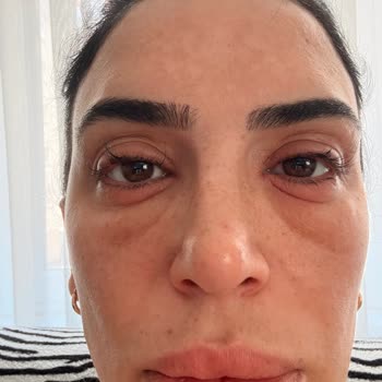 Flormar Göz Kalemi Kullanımından Sonra Şiddetli Alerjik Reaksiyon Ve Şirketin Yetersiz Cevabı