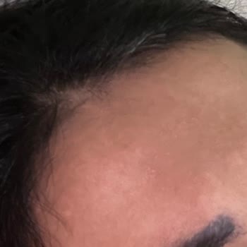 L'Loreal Paris Nemlendirici Krem Kullanımından Sonra Ciltte Belirgin Koyu Lekeler Ve Mağduriyet