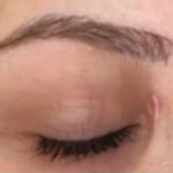 Apex Şişli Tıp Merkezi'nde Lazer Göz Kapağı İşlemi Sonrası İz Ve Ücret İadesi Talebi