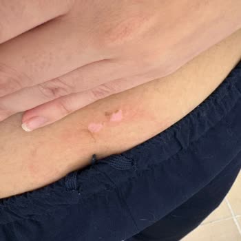 Lady Comfort Isıtıcı Pedi Cildimde Yanık Ve Şiddetli Tahrişe Neden Oldu