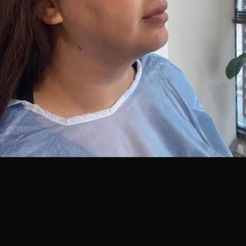 Antalya Sym Estetik Kliniğinde Gıdı Liposuction İşlemi Sonucu Hayal Kırıklığı Ve Tam İade Talebi