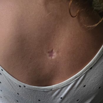 Medicana Ataköy Hastanesi Dermatoloji İşleminde Derin Boşluk Ve İz