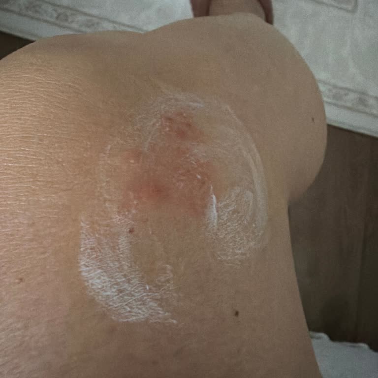 Velavit Ceramide V Kapsüllerinde Cilt Reaksiyonu Ve Güven Kaybı