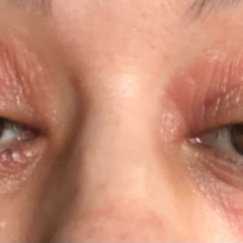 Atoderm Göz Çevresi Kremi Şiddetli Yanma Ve Yaşarma Yaratıyor, Tazminat İstiyorum