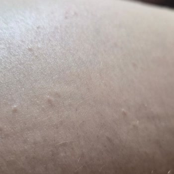 Nivea Q10 Vücut Kremi Cilt Reaksiyonu Ve Güven Kaybı