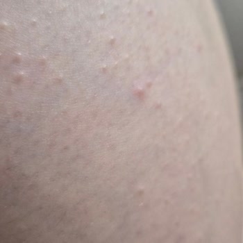 Nivea Q10 Vücut Kremi Cilt Reaksiyonu Ve Güven Kaybı