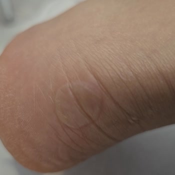 Kinetix Ayakkabısında Şiddetli Ağrı Ve Su Toplanması, İade Talebi