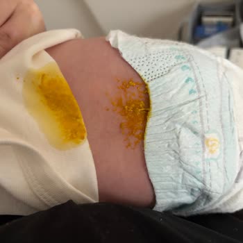 Prima Premium Care 3 Bebek Bezi Sızdırma Ve Şiddetli Pişik Problemi