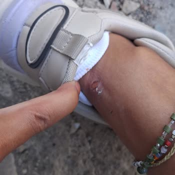 Üç Kez Giyilen Ayakkabıda Şiddetli Ayak Yaralanması Ve Deri Çatlağı İade Talebi