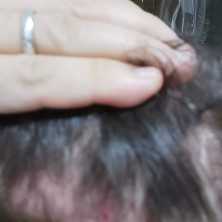 Bioxcin Siyah Sarımsaklı Şampuan Saç Derisinde Kaşıntı Ve Sivilce Nedeniyle İade Talebi
