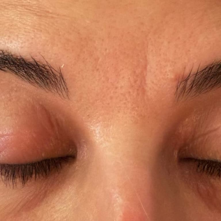 Bioderma Atoderm Göz Kremi Yanma Ve Şişlik İade Talebi