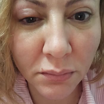 Planet Essence Botulux Cream Caused Facial Swelling and Severe Itching