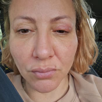 Planet Essence Botulux Cream Caused Facial Swelling and Severe Itching