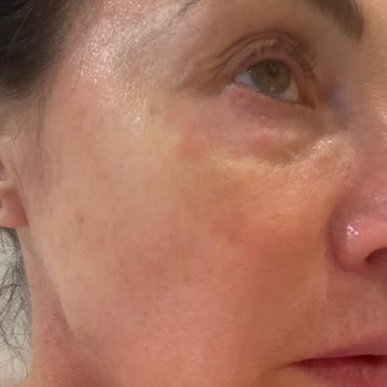 Serum Hyalu B5 de La Roche-Posay causa reacción alérgica, solicito revisión