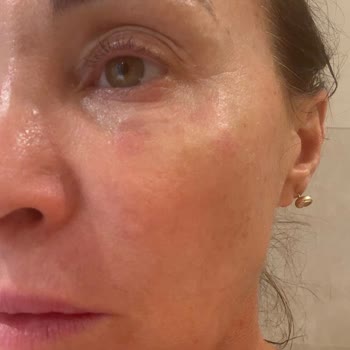Serum Hyalu B5 de La Roche-Posay causa reacción alérgica, solicito revisión