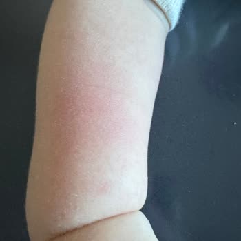 Prospan Şurubu Bebekte Alerjik Döküntü Ve Uyarı İhmaline Karşı İade Talebi